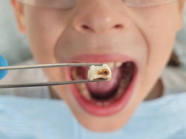 Best Emergency Broken Tooth Repair in Lincoln, AL